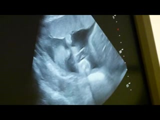 Ultrasound2011 Mar 29 Trimmed.wmv