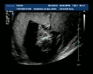 Ultrasound Dec9 Part2.avi