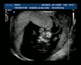 Ultrasound Dec9 Part3.avi