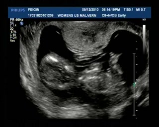Ultrasound Dec9 Part4.avi