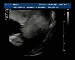 Ultrasound Dec9 Part5.avi